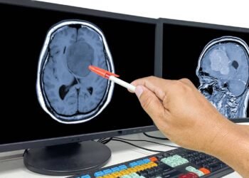 Dr. Cesar Cimonari, Neurocirurgião: Sintomas de gliomas que você não deve ignorar