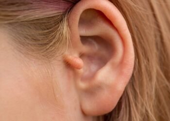 Malformação de orelha em crianças exige cirurgia sempre?