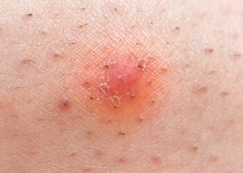 A solução mais eficaz para quem sofre com pelos encravados