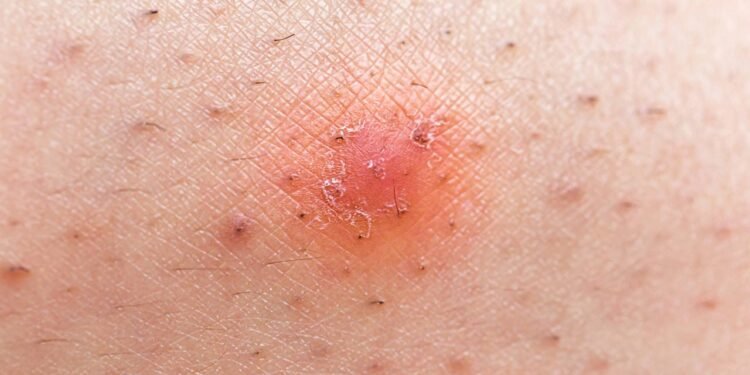 Pelos Encravados - Créditos: depositphotos.com / lobster20