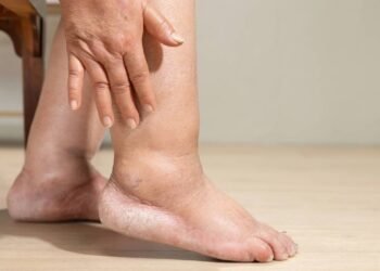 O método natural mais eficaz para aliviar pés inchados