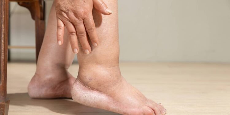 Pés Inchados - Créditos: depositphotos.com / toa55