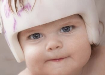 Dr. Cesar Cimonari: Cabeça achatada em bebês merece atenção