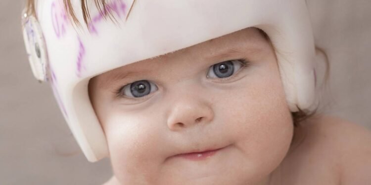 Plagiocefalia - Créditos: depositphotos.com / txking