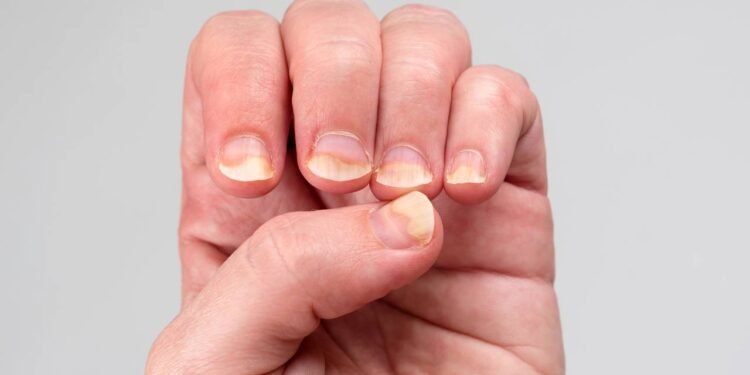 Unhas Frágeis - Créditos: depositphotos.com / Magryt_Artur