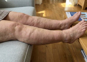 Os hacks de exercícios e hábitos que ajudam a amenizar o lipedema nas pernas e melhorar o bem-estar