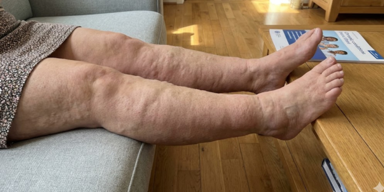 Os hacks de exercícios e hábitos que ajudam a amenizar o lipedema nas pernas e melhorar o bem-estar