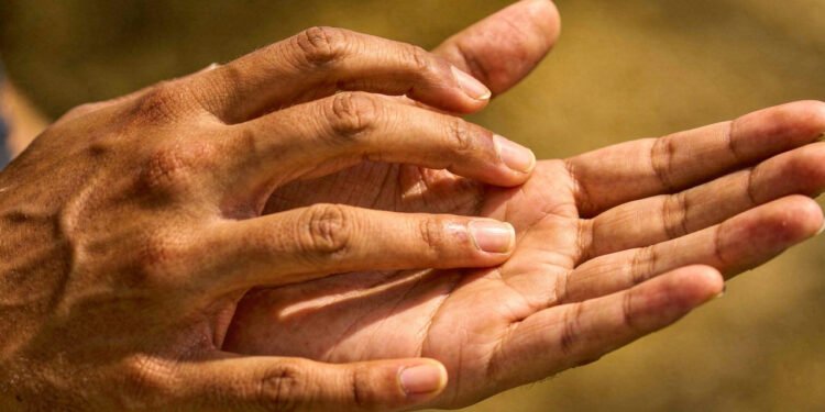 O que significa coçar a palma da mão, segundo crenças populares