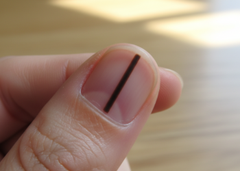 Unhas com linhas escuras: quando uma mancha simples pode sinalizar algo grave