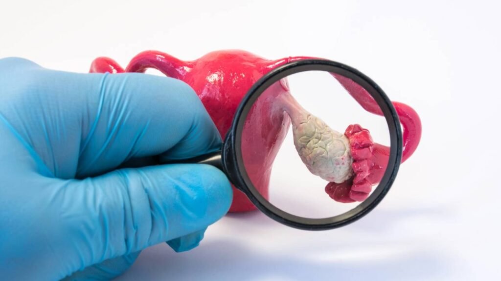 Quais são os sintomas mais comuns em mulheres com ovários policísticos?