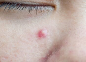 O tipo de acne que não deve ser espremido jamais