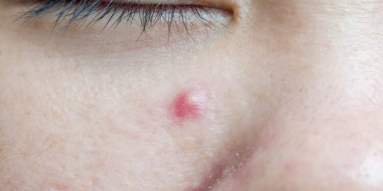 O erro comum no tratamento da acne cística que piora tudo - Créditos: depositphotos.com / wyoosumran