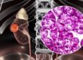 Câncer renal silencioso pode causar dor e sangue