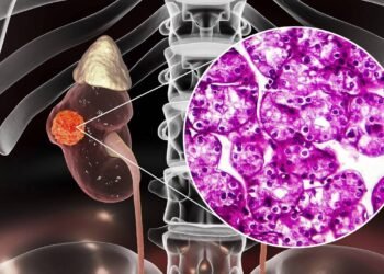 Câncer renal silencioso pode causar dor e sangue