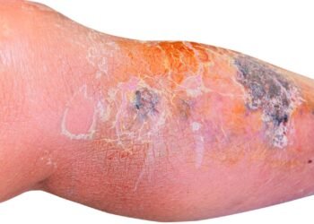 A melhor forma de tratar celulite infecciosa e evitar sepse