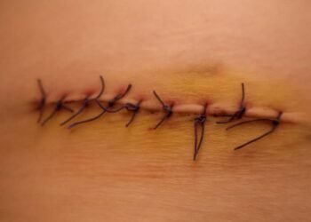 Os alimentos mais importantes para cicatrizar mais rápido