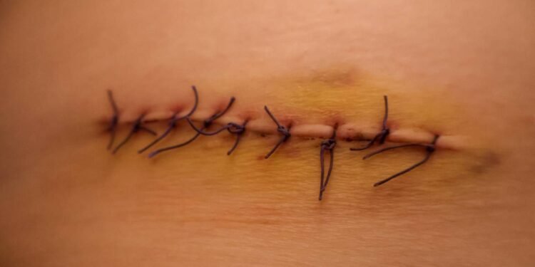 Os erros alimentares que atrasam cicatrização e inflamação - Créditos: depositphotos.com / KatTarasenko