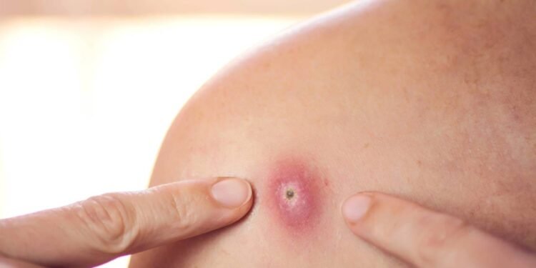 A estratégia mais eficaz para tratar foliculite na virilha e evitar manchas - Créditos: depositphotos.com / dexteris