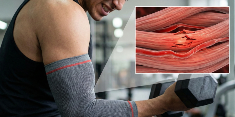 O que acontece com seus músculos quando você treina mesmo sentindo dor tardia