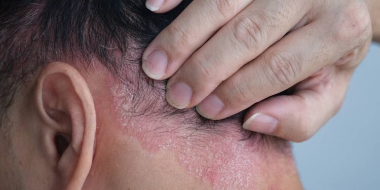 A estratégia moderna que ajuda a interromper crises de psoríase - Créditos: depositphotos.com / wisely