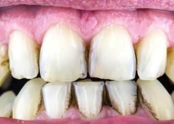 Bicarbonato remove tártaro? Veja o que é mito e verdade