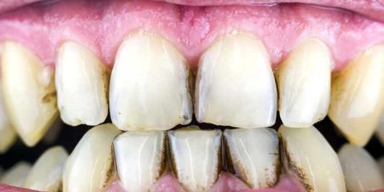 Como evitar o acúmulo de tártaro nos dentes - Créditos: depositphotos.com / schigirin91@gmail.com