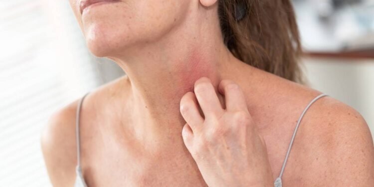 Dieta anti-inflamatória ajuda a controlar dermatite e diminuir vermelhidão - Créditos: depositphotos.com / thodonal