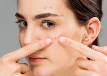 O que realmente funciona para prevenir espinhas no dia a dia