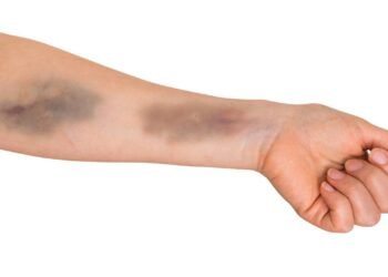 Hematomas sem causa aparente podem indicar doença