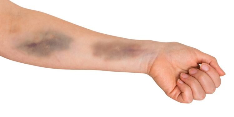 Quando o estresse afeta vasos e causa hematomas - Créditos: depositphotos.com / andriano_cz