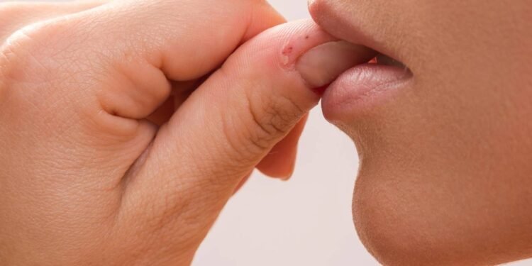 Onicofagia pode estar ligada à ansiedade e exigir apoio profissional - Créditos: depositphotos.com / AY_PHOTO