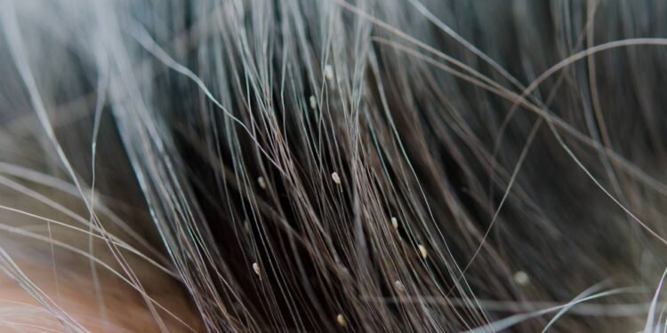 A forma mais eficaz de identificar pediculose antes que se espalhe - Créditos: depositphotos.com / aoo8449