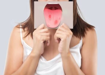 O método mais eficaz que combate a candidíase oral e alivia a dor rapidamente