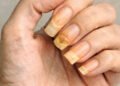 O que significa quando as unhas ficam amareladas?