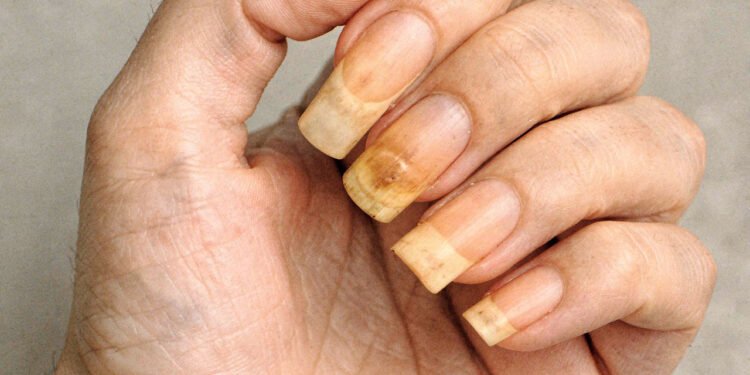 O que significa quando as unhas ficam amareladas?