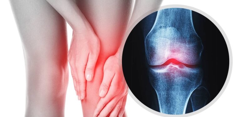 Atividade física pode melhorar a dor da osteoartrite - Créditos: depositphotos.com / AY_PHOTO