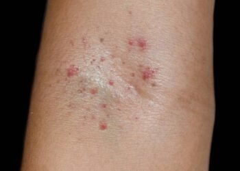 Manchas vermelhas na pele podem indicar problema no fígado