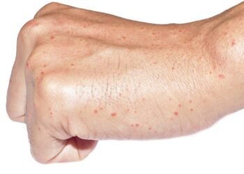 Manchas vermelhas na pele podem indicar problema no fígado