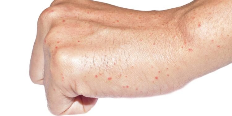 Pintas vermelhas podem ser benignas ou indicar risco hepático - Créditos: depositphotos.com / zaynyinyi