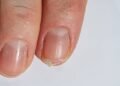 O sinal mais importante nas unhas que pode indicar anemia e falta de ferro silenciosa
