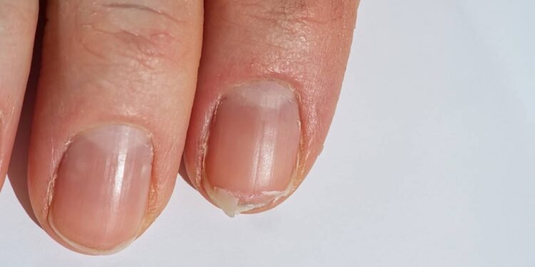 O alerta nas unhas que pode revelar anemia e explicar sintomas inexplicáveis - Créditos: depositphotos.com / FotoPrivet