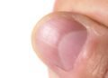 O sinal mais importante nas unhas que pode indicar anemia e falta de ferro silenciosa