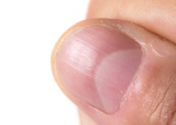 O sinal mais importante nas unhas que pode indicar anemia e falta de ferro silenciosa
