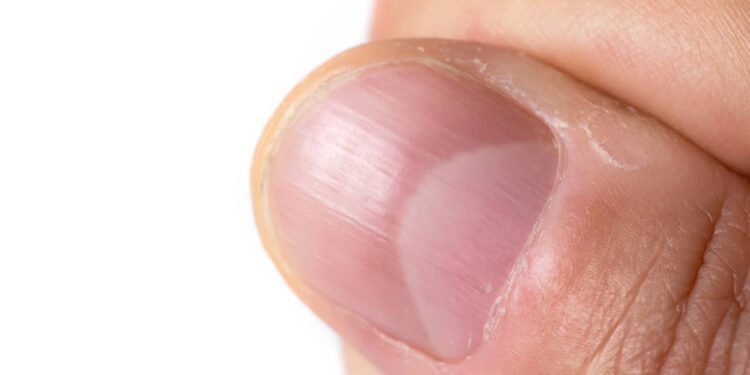 O detalhe nas unhas que revela anemia e explica cansaço e fraqueza constantes - Créditos: depositphotos.com / eliosdnepr@gmail.com