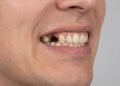 Perda de dentes pode alterar formato do rosto e afetar mastigação, alerta especialista