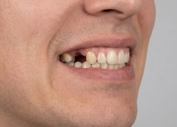 Perda de dentes pode alterar formato do rosto e afetar mastigação, alerta especialista