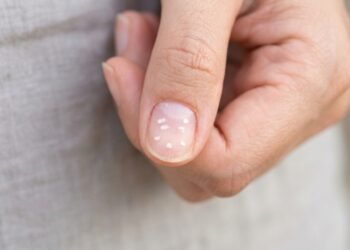 O que significa quando surgem manchas brancas nas unhas