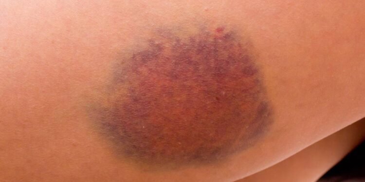 Hematomas espontâneos podem revelar alterações na coagulação- Créditos: depositphotos.com / Mayalain