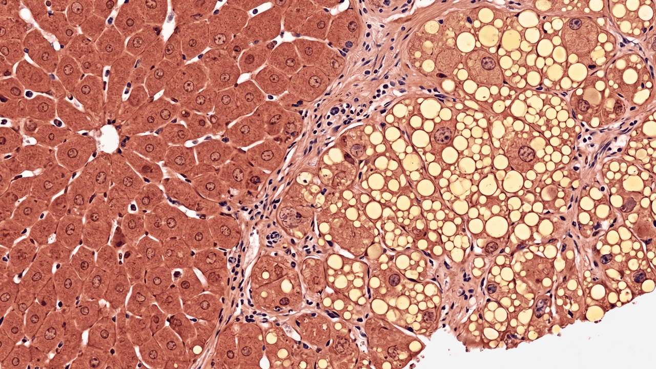 Estudo mostra os efeitos da cerveja no fígado e na saúde cardiovascular