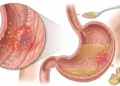 O que o gengibre em jejum faz no estômago e na inflamação
